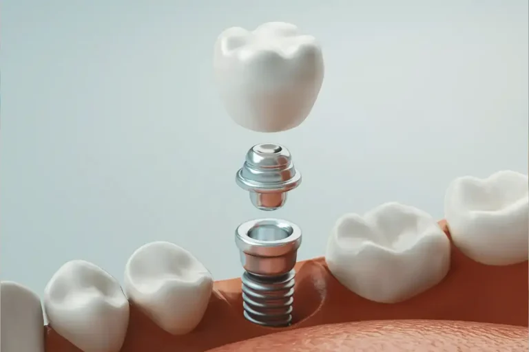 Dental Implants in Santa Rosa Beach, FL at Santa Rosa Beach Dental