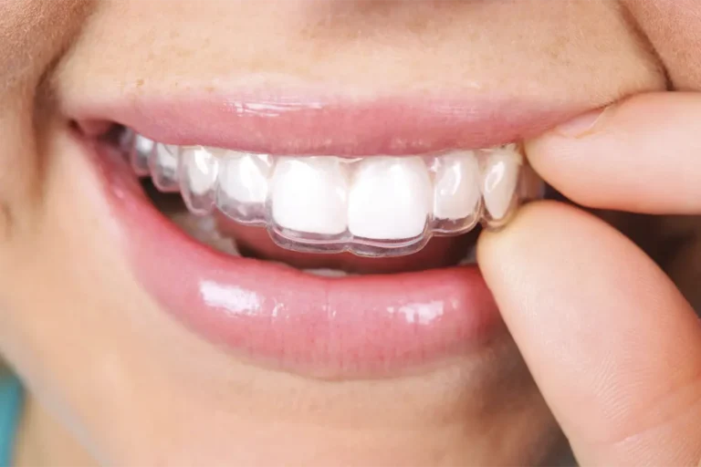 Invisalign in Santa Rosa Beach, FL at Santa Rosa Beach Dental