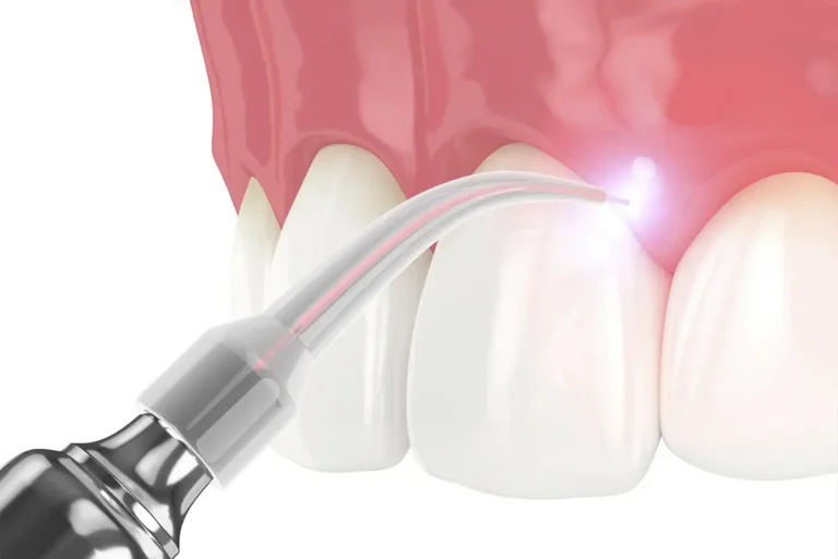 Soft-Tissue Dental Laser in Santa Rosa Beach, FL at Santa Rosa Beach Dental